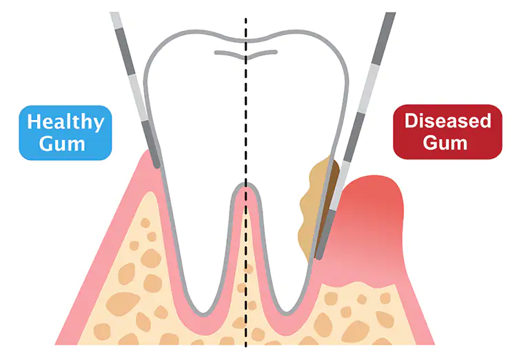 Healthy and diseased gum