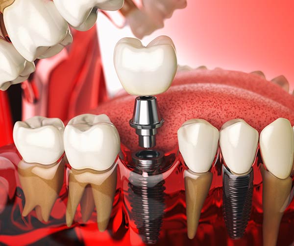 3D model showing how dental implants are placed